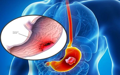 Chàng trai 25 tuổi bị ung thư dạ dày giai đoạn cuối vì thói quen khó bỏ