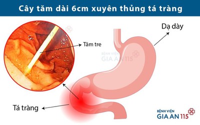 Hoảng hồn bệnh nhân bị tăm đâm thủng ruột mà không hay biết