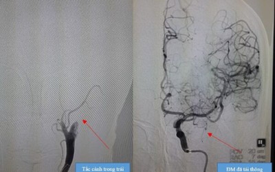 Bất ngờ bị đột quỵ khi đang ăn cơm trưa