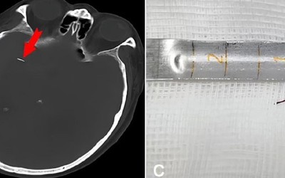 Người đàn ông sống 20 năm với chiếc kim trong não vì lý do hi hữu