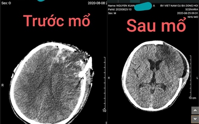 Ly kỳ ca cứu chữa thành công nạn nhân bị tai nạn xe máy, não lồi ra ngoài hộp sọ