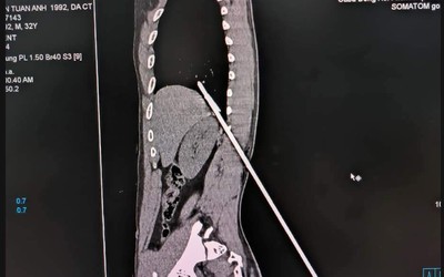 Cứu người đàn ông bị mũi tên bằng thép đâm xuyên lưng lên phổi