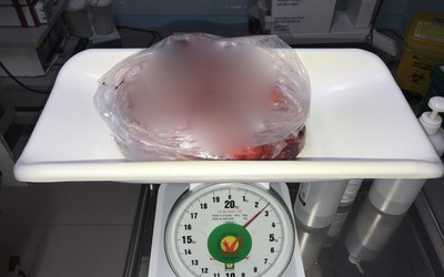 Đồng Nai: Cắt bỏ khối u nặng 2,5kg trong ngực người đàn ông