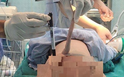 Phẫu thuật cắt bỏ "đuôi" hiếm gặp ở em bé 4 tháng dài theo thời gian
