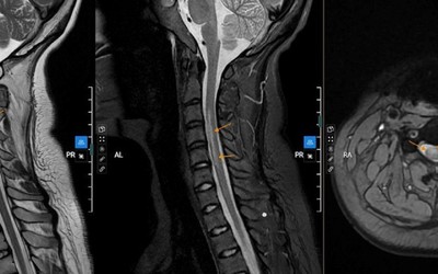 Bản tin 25/4: Thường xuyên tắm muộn, nữ sinh 20 tuổi bị liệt tay