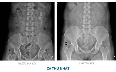 Khánh Hòa: Tán sỏi san hô qua da bằng đường hầm nhỏ cho 2 bệnh nhân