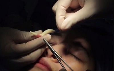 Hotgirl sưng nề mặt 2 năm vì cục gạc "mắc kẹt" trong mũi