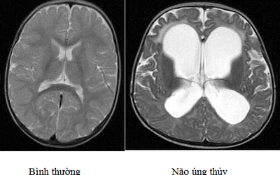 Bé trai bị não úng thủy to như quả bóng tử vong