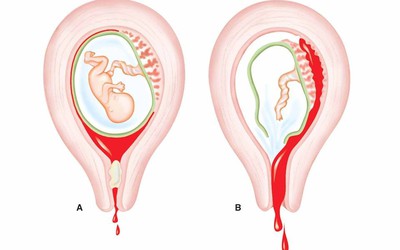 Bà bầu bị vỡ tử cung khi mang thai tuần 38: Đau đớn mất đứa con đầu lòng