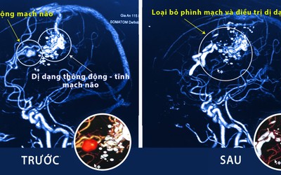 Cẩn trọng với những cơn đau đầu dữ dội của người trẻ