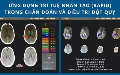 Người phụ nữ đột quỵ khi đang phơi quần áo được cứu sống kịp thời