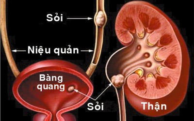 Hi hữu bé gái 9 tuổi viêm sỏi thận to bằng viên bi