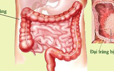 Sáng chế “đột phá” của người Nhật trong hỗ trợ điều trị viêm đại tràng