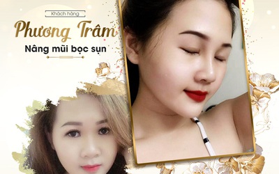 Ngẩn ngơ trước vẻ đẹp của những cô nàng sau nâng mũi bọc sụn