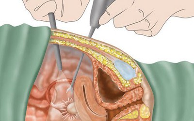 Thảo dược Nga Phụ Khang giúp hỗ trợ chữa u nang buồng trứng không cần mổ