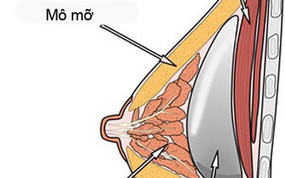 3 vị trí đặt túi ngực cho hiệu quả thẩm mỹ tốt nhất trong nâng ngực