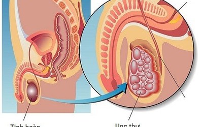 Ung thư tinh hoàn không còn nguy hiểm nếu được phát hiện sớm