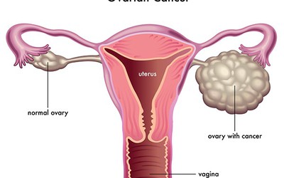 Nên tầm soát ung thư buồng trứng ở đâu tốt nhất?