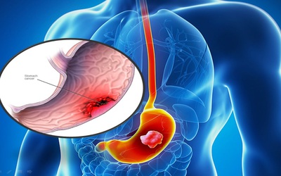 Ung thư dạ dày di căn nguy hiểm đến tính mạng như thế nào?