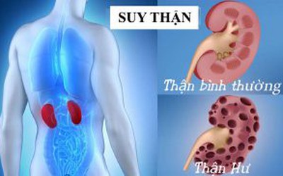 Cảnh báo nguy cơ suy thận cao với những dấu hiệu thường thấy