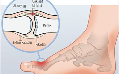 Nguyên nhân và cách điều trị bệnh gout