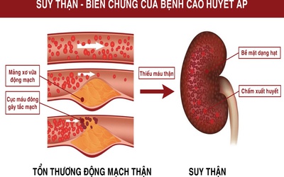 Huyết áp cao và nguy cơ gây biến chứng suy thận