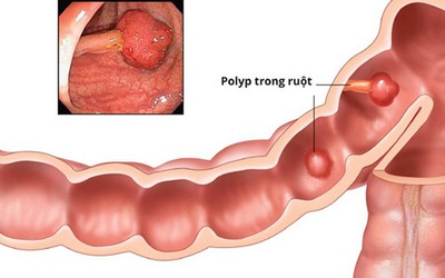 Các biện pháp phòng tránh ung thư đại tràng