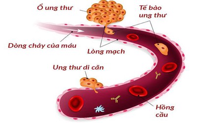 Dấu hiệu nhận biết của từng loại ung thư phổi di căn