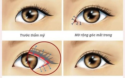 Mở rộng góc mắt có sẹo không?