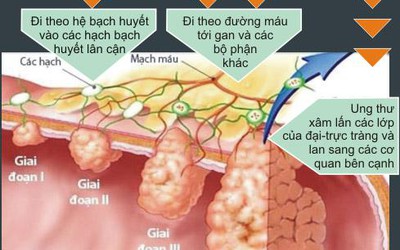 Nguy cơ mắc bệnh ung thư chỉ vì viêm đại tràng lâu năm