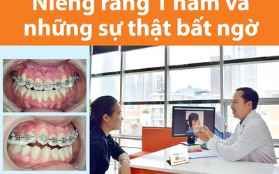 Niềng răng 1 hàm và những sự thật bất ngờ bạn nên biết