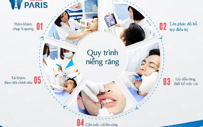 Niềng răng năm 30 tuổi, tại sao không?