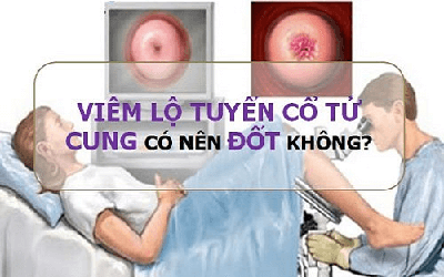 Viêm lộ tuyến cổ tử cung có nên đốt điện không?