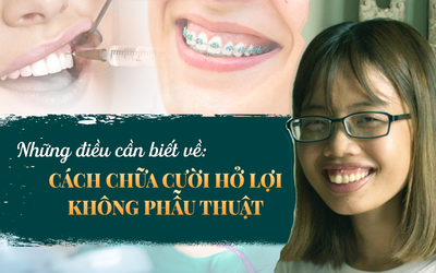 Những điều cần biết về cách chữa cười hở lợi không phẫu thuật