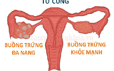 Hội chứng buồng trứng đa nang và cách điều trị