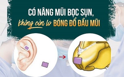 Nâng mũi bọc sụn tai - Mũi cao tự nhiên, không lo biến chứng