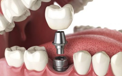 Cấy ghép implant có đau không, biến chứng khi làm sai quy trình