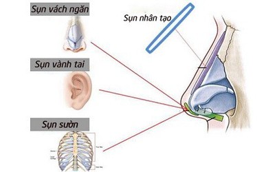 Nên nâng mũi sụn nhân tạo hay nâng mũi bọc sụn tự thân?