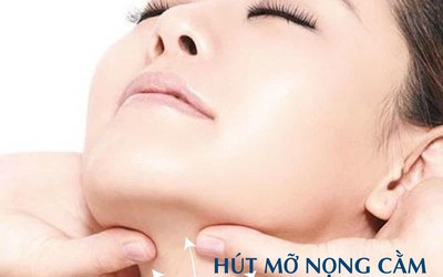 Hút mỡ nọng cằm Laser Lipo - Xóa tan mỡ nọng cằm triệt để