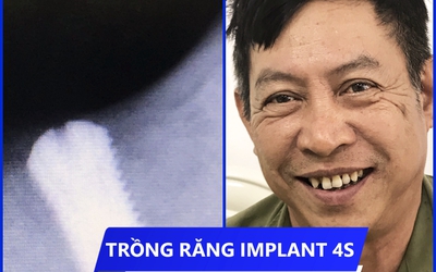 Trồng răng implant giúp cha mẹ cười đẹp ăn ngon vui đón Tết