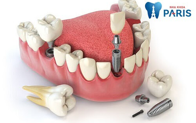 Trồng răng Implant loại nào tốt - 4 tips lựa chọn cực hay