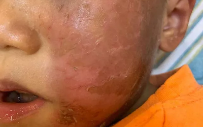 Khiếp hãi bé 4 tuổi bỏng rộp da mặt vì đeo mặt nạ hóa trang Halloween