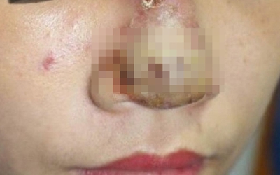 Nữ bệnh nhân xuất hiện ổ mủ trên mũi sau khi tiêm filler làm đẹp