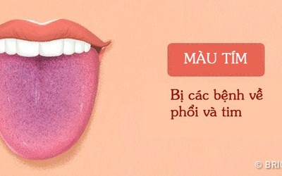 Màu sắc lưỡi tiết lộ các vấn đề sức khỏe