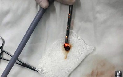 Cứu sống bé 7 tháng tuổi bị hóc hạt dưa