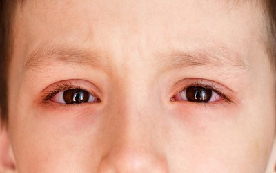 Những hiểu lầm truyền miệng về bệnh đau mắt đỏ