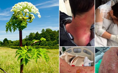 Giant hogweed: Loài cây cực độc khiến con người bị bỏng và mù vĩnh viễn