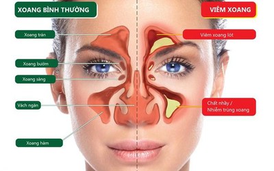 Bài thuốc trị viêm xoang từ thảo mộc thiên nhiên cực hữu hiệu