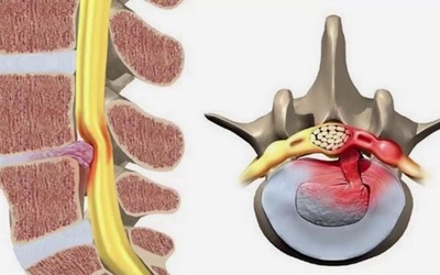 6 địa chỉ điều trị thoát vị đĩa đệm tại Hà Nội