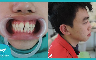 Chàng du học sinh Lào và những kỉ niệm khó quên khi niềng răng tại Nha khoa Smile One